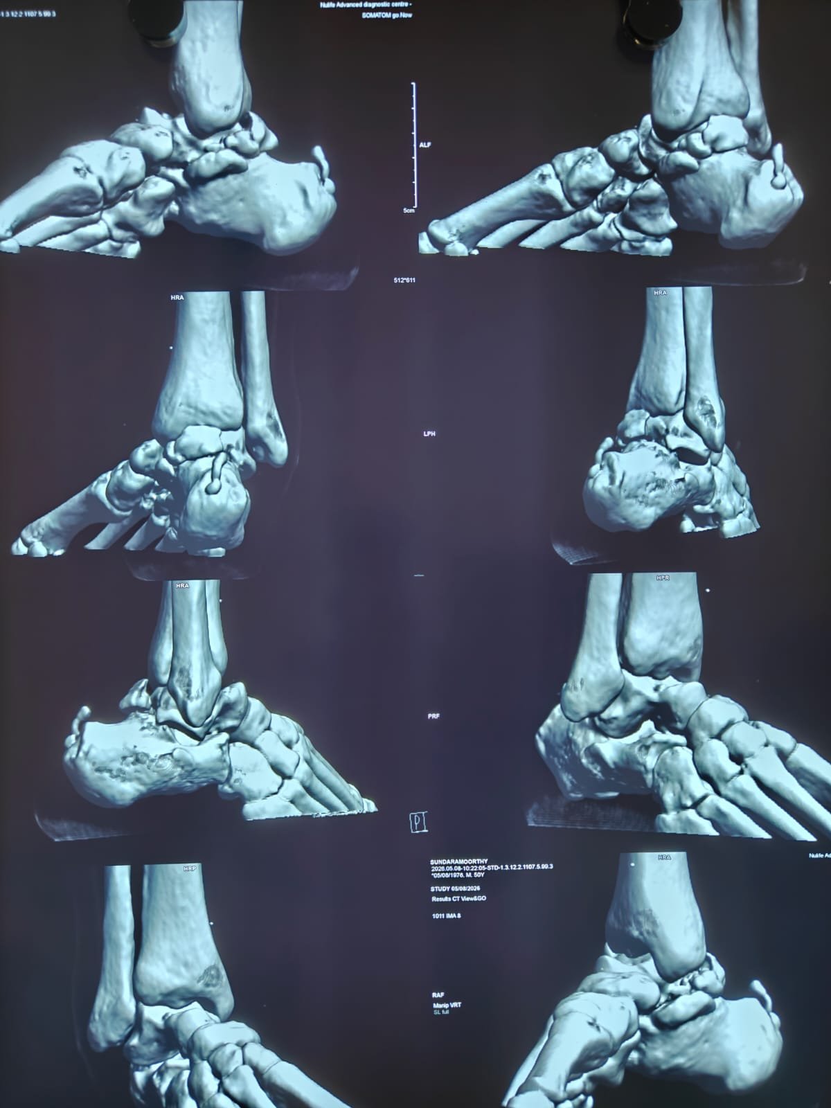 Herbert screw fixation